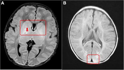 Case Report: Progressive Cholestasis: Severe Phenotype of MEGDEL Syndrome With SATB2-Associated Syndrome